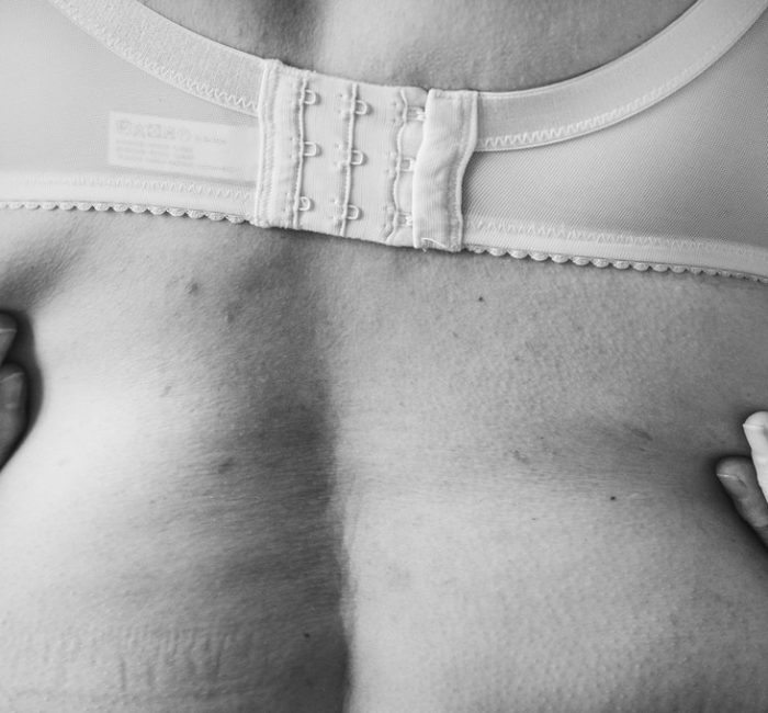 Intradermoterapia: o procedimento que reduz a gordura corporal