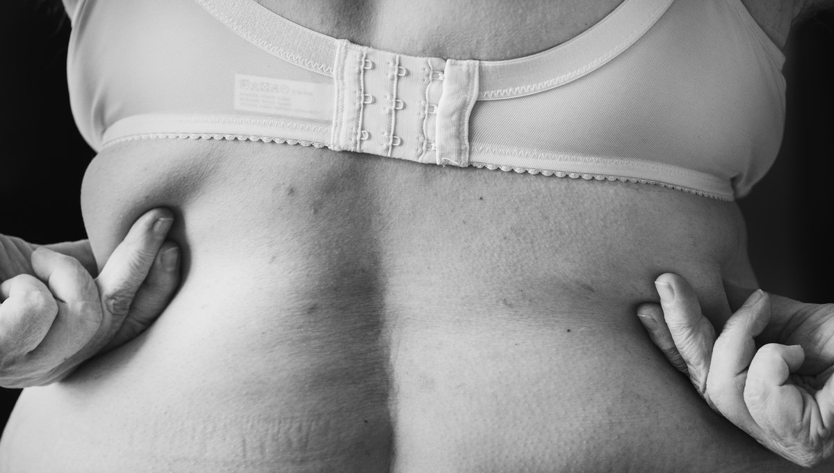 You are currently viewing Intradermoterapia: o procedimento que reduz a gordura corporal